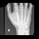 Os epipyramis, accessory bone: X-ray - Plain radiograph